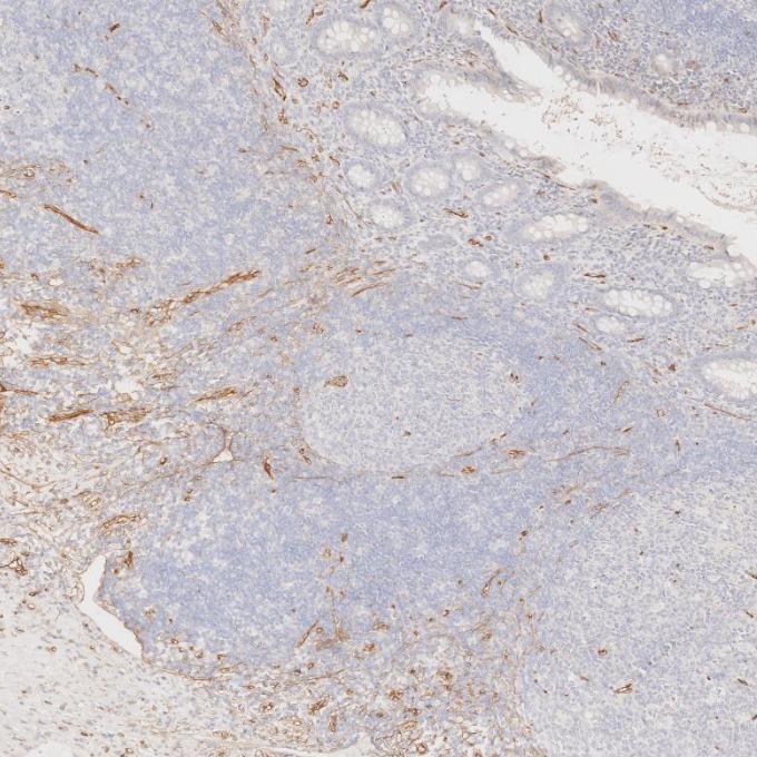 IHC staining of human appendicitis using 60180-2-Ig