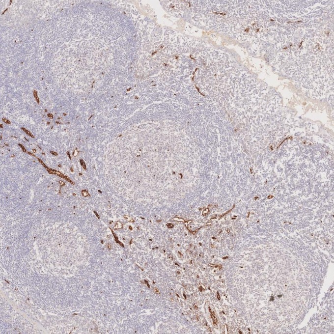 IHC staining of human tonsillitis using 60180-2-Ig