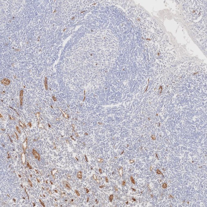 IHC staining of human tonsillitis using 60180-2-Ig