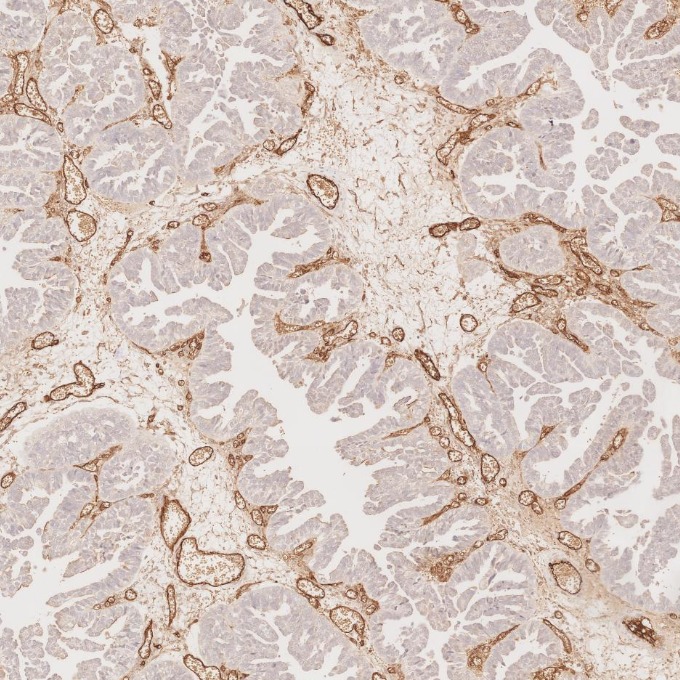 IHC staining of human ovary cancer using 60180-2-Ig