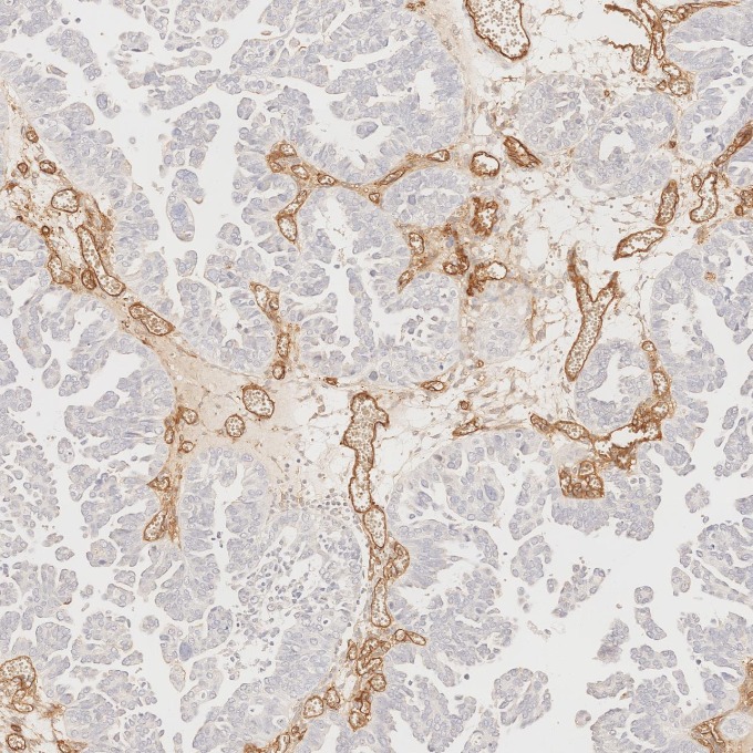 IHC staining of human ovary cancer using 60180-2-Ig