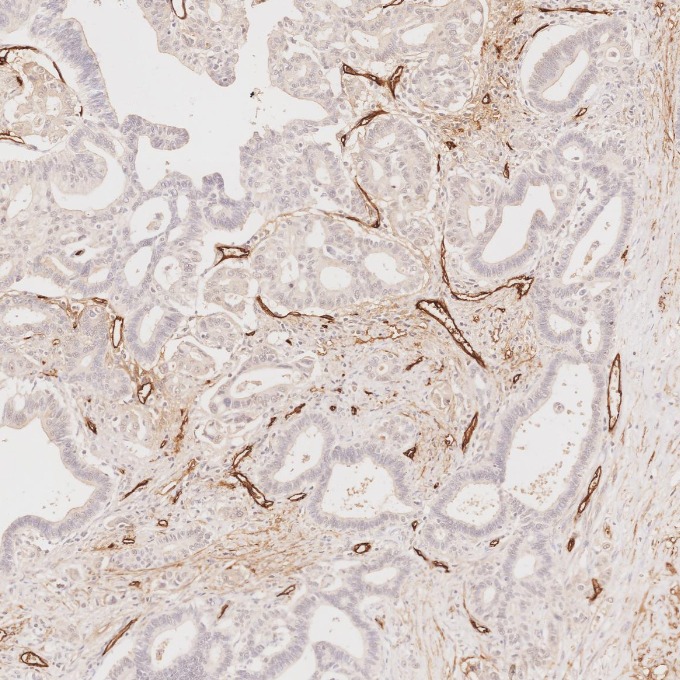 IHC staining of human pancreas cancer using 60180-2-Ig