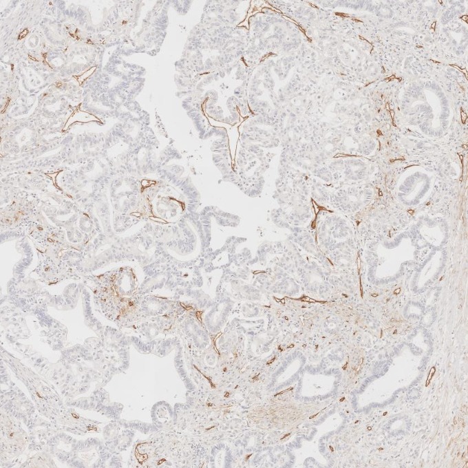 IHC staining of human pancreas cancer using 60180-2-Ig