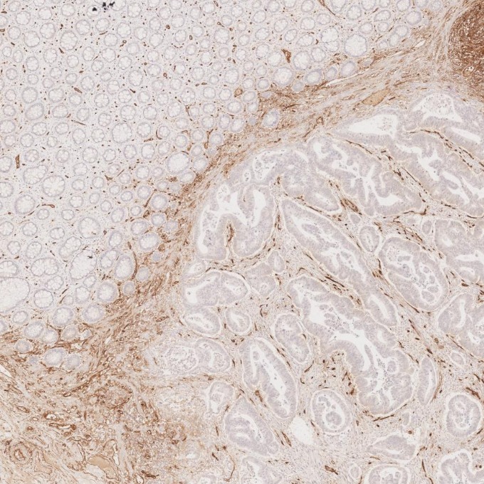 IHC staining of human colorectal cancer using 60180-2-Ig