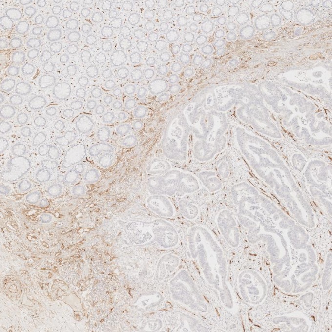 IHC staining of human colorectal cancer using 60180-2-Ig
