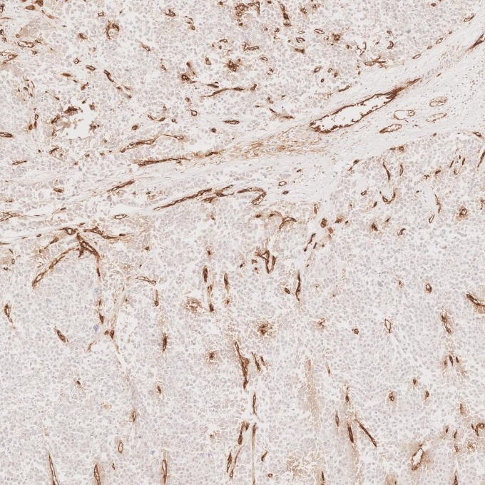 IHC staining of human liver cancer using 60180-2-Ig