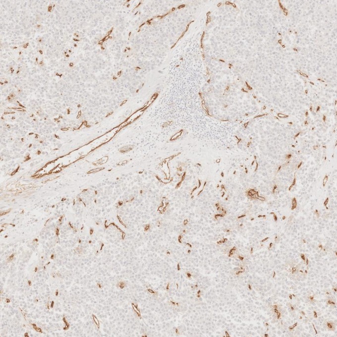 IHC staining of human liver cancer using 60180-2-Ig
