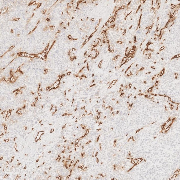 IHC staining of human liver cancer using 84242-5-RR
