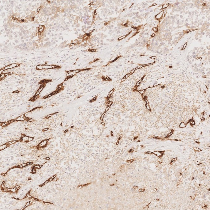 IHC staining of human liver cancer using 84242-5-RR