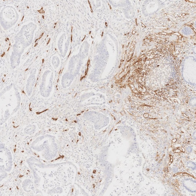 IHC staining of human colorectal cancer using 84242-5-RR