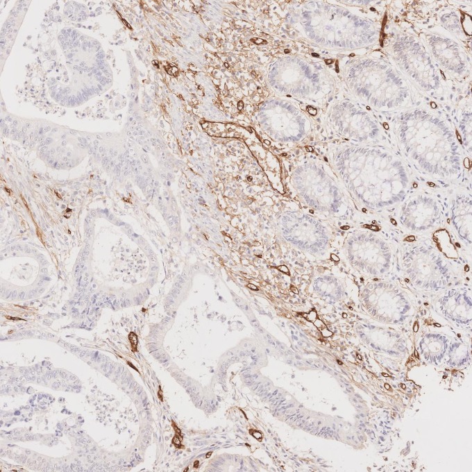 IHC staining of human colorectal cancer using 84242-5-RR