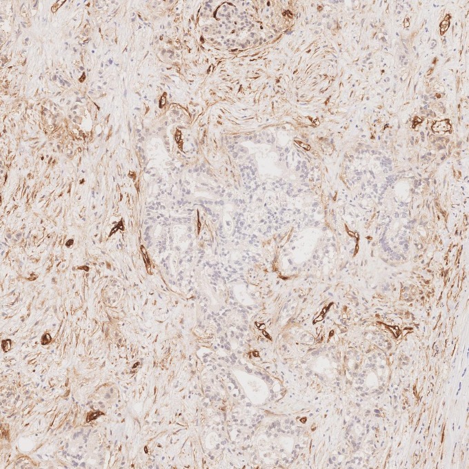 IHC staining of human pancreas cancer using 84242-5-RR