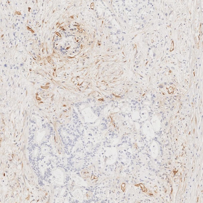 IHC staining of human pancreas cancer using 84242-5-RR