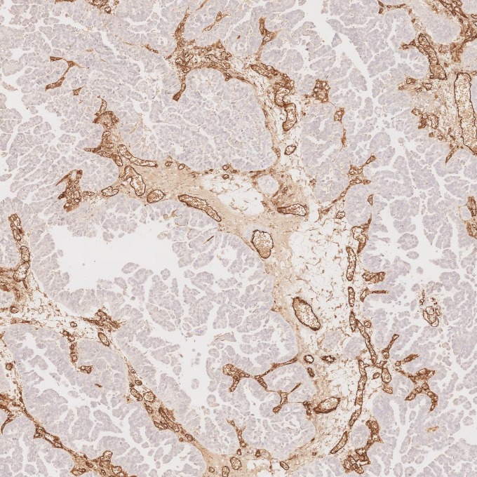IHC staining of human ovary cancer using 84242-5-RR