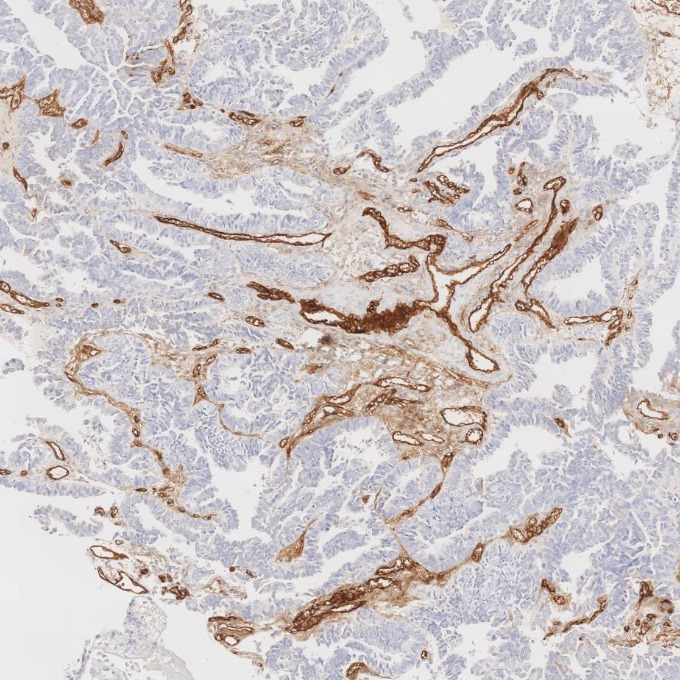 IHC staining of human ovary cancer using 84242-5-RR