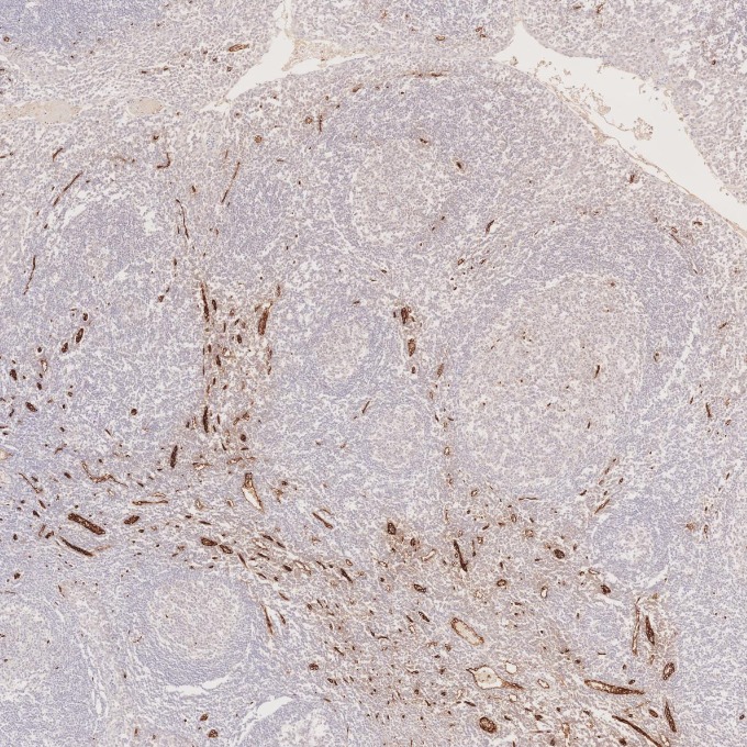 IHC staining of human tonsillitis using 84242-5-RR