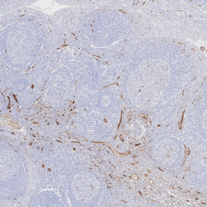 IHC staining of human tonsillitis using 84242-5-RR