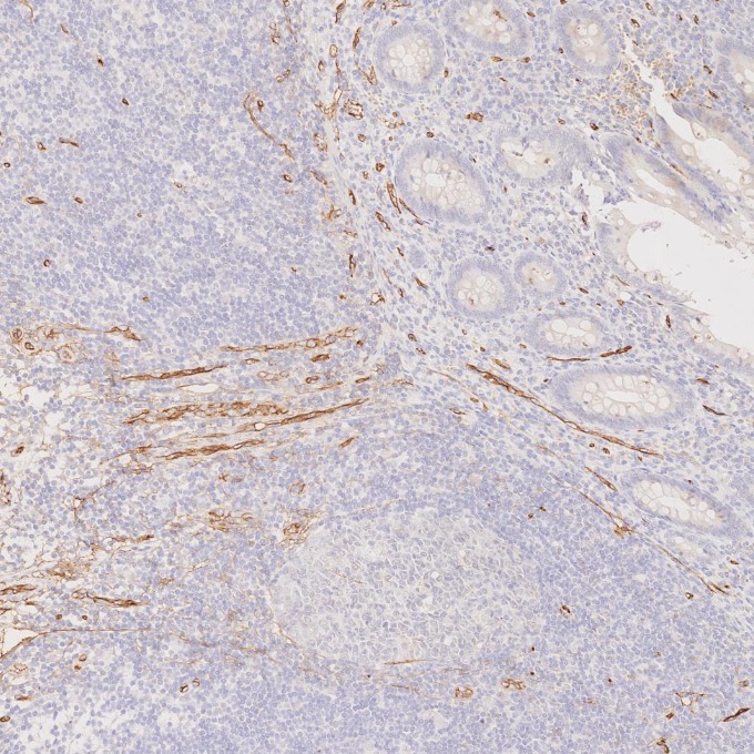 IHC staining of human appendicitis using 84242-5-RR
