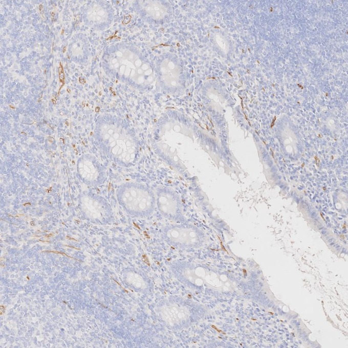 IHC staining of human appendicitis using 84242-5-RR