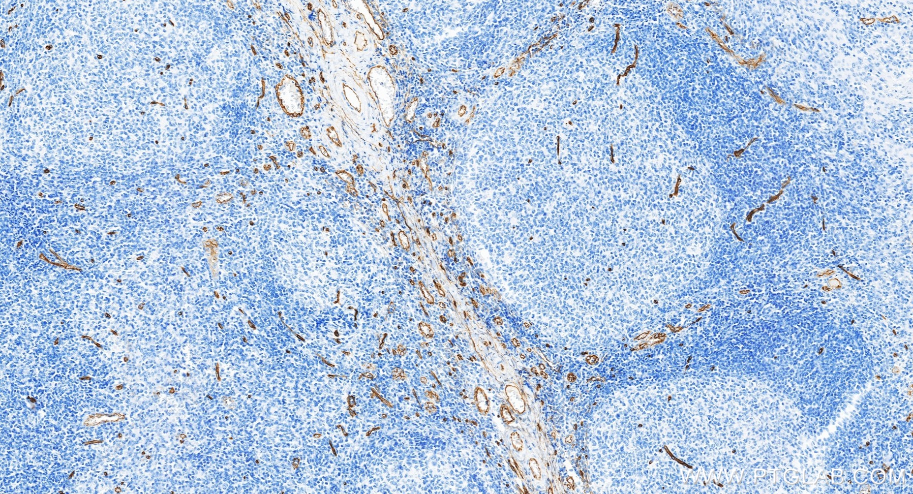 IHC staining of human tonsillitis using 84242-5-RR