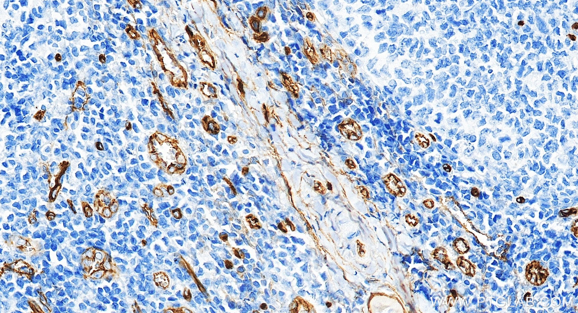 IHC staining of human tonsillitis using 84242-5-RR