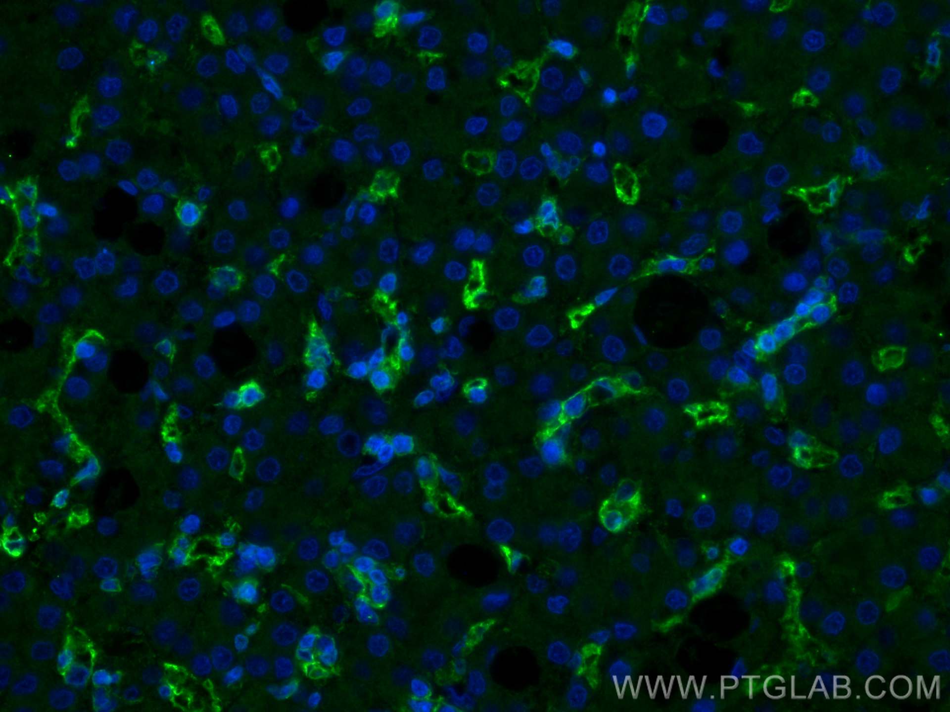 IF Staining of human liver cancer using 66395-1-Ig (same clone as 66395-1-PBS)