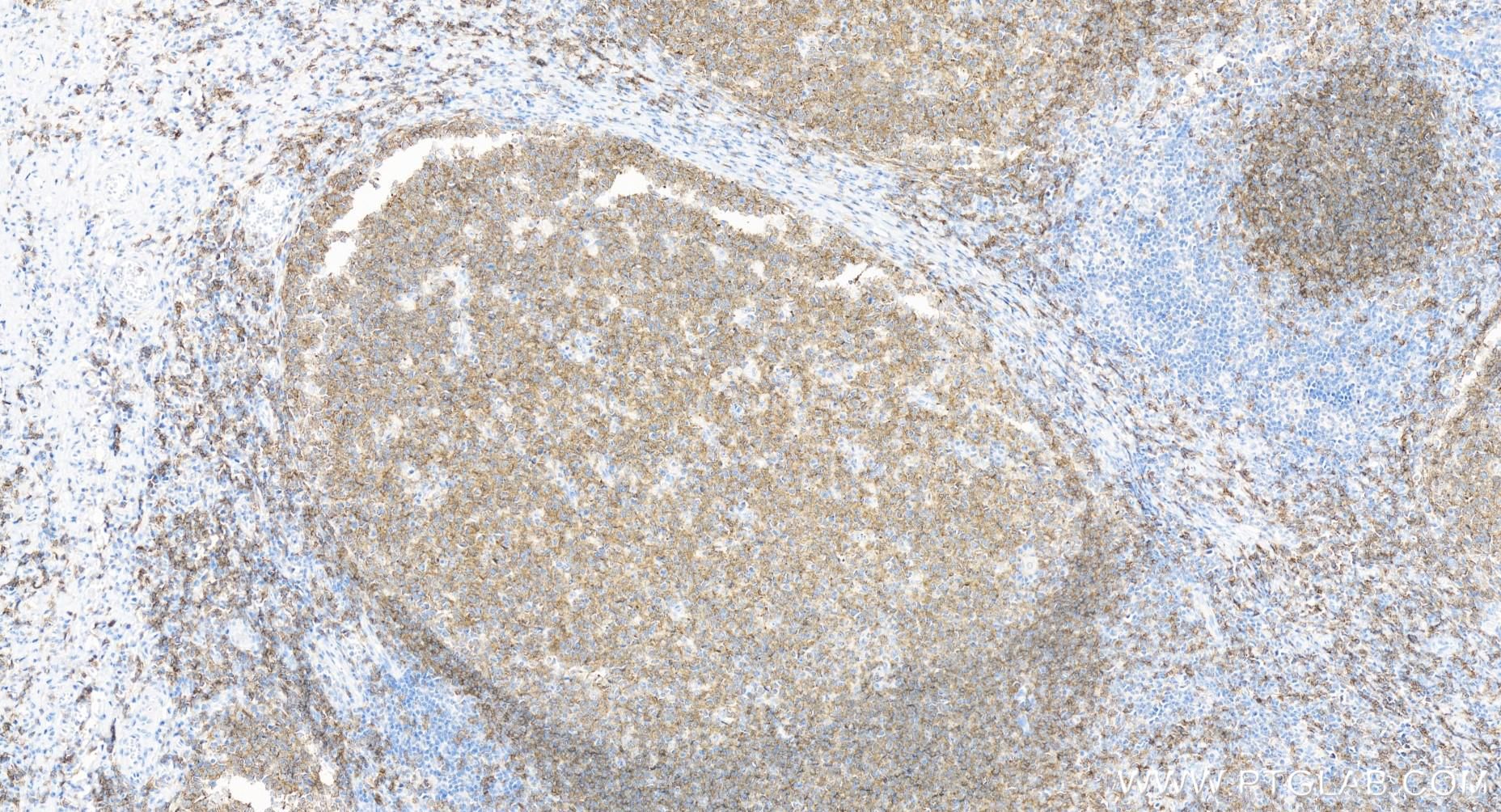 IHC staining of human tonsillitis using 84509-2-RR