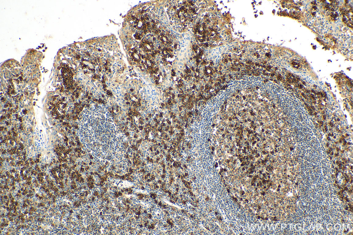 IHC staining of human tonsillitis using 25284-1-AP