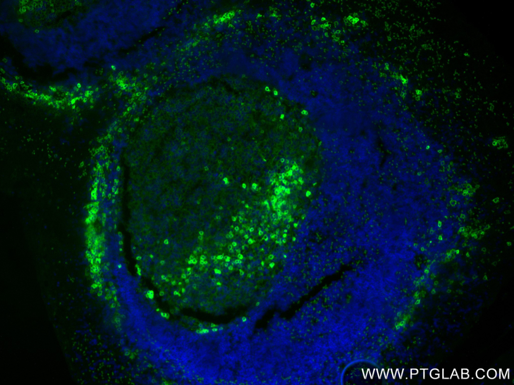 IF Staining of human tonsillitis using 84070-6-RR IF Staining of human tonsillitis using 84070-6-RR