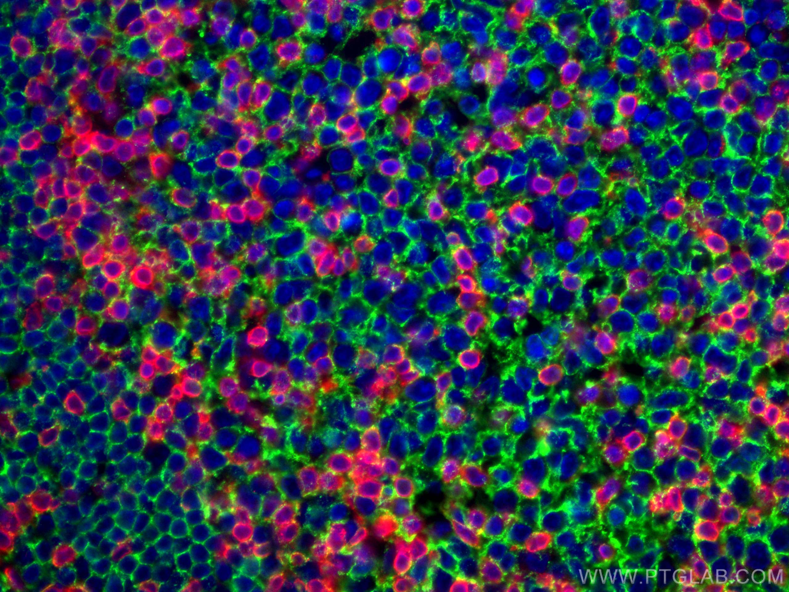 IF Staining of human tonsillitis using 60181-1-Ig