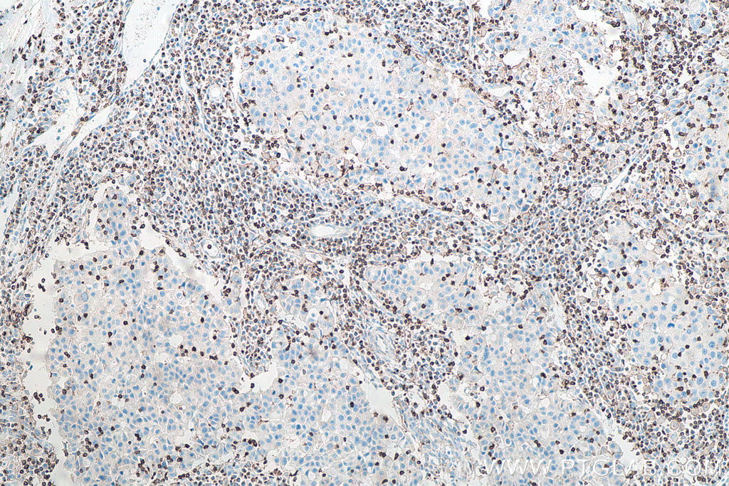IHC staining of human breast cancer using 60181-1-Ig
