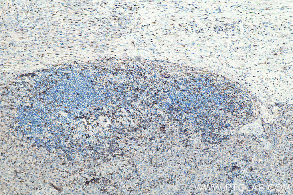 IHC staining of human lymphoma using 60181-1-Ig