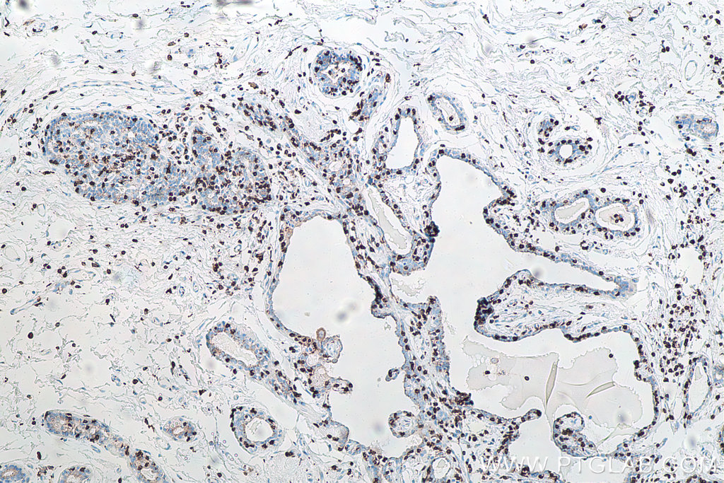 IHC staining of human breast cancer using 60181-1-Ig