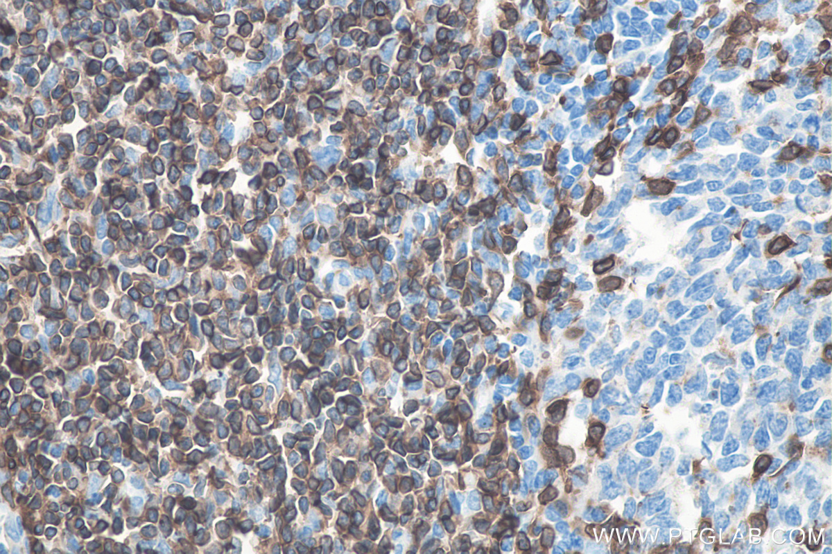 IHC staining of human tonsillitis using 60181-1-Ig (same clone as 60181-1-PBS)