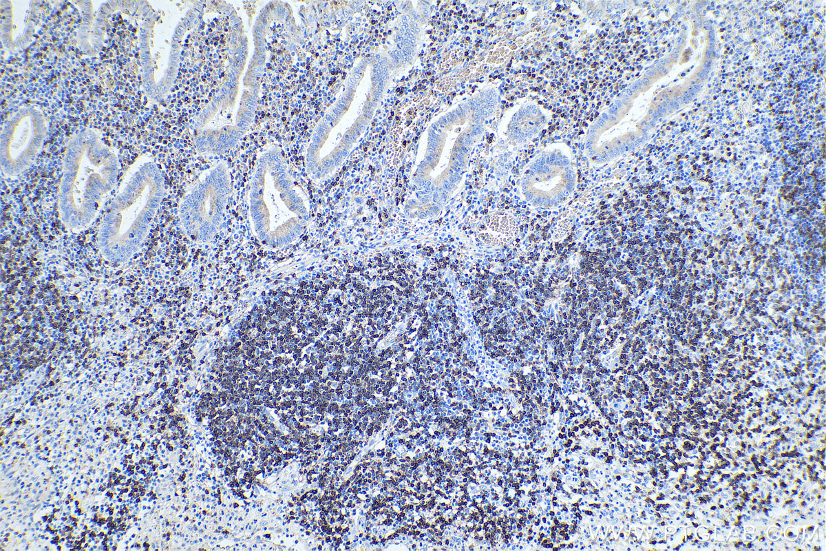 IHC staining of human appendicitis using 60181-1-Ig