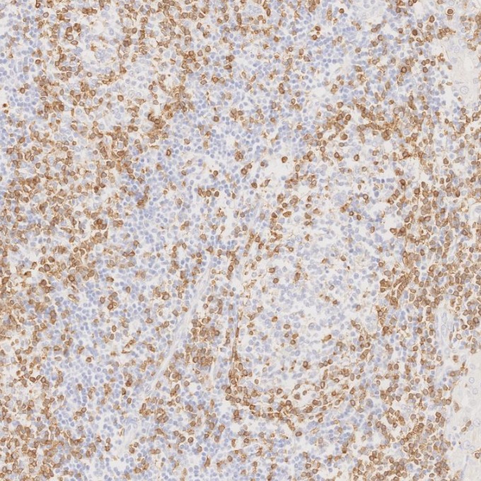 IHC staining of human lymphoma using 60181-1-Ig