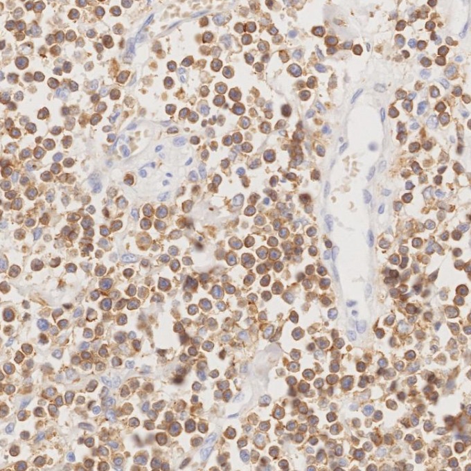 IHC staining of human lymphoma using 60181-1-Ig
