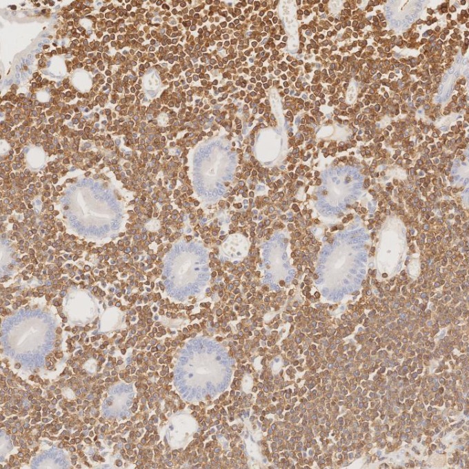 IHC staining of human lymphoma using 60181-1-Ig