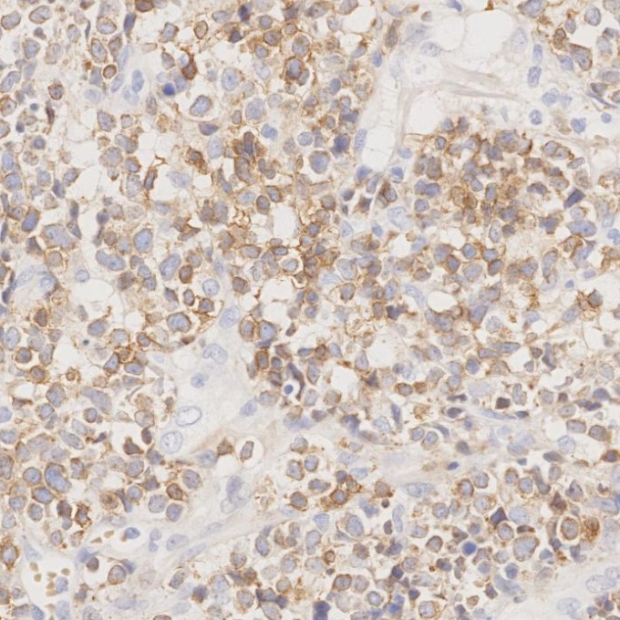 IHC staining of human lymphoma using 60181-1-Ig