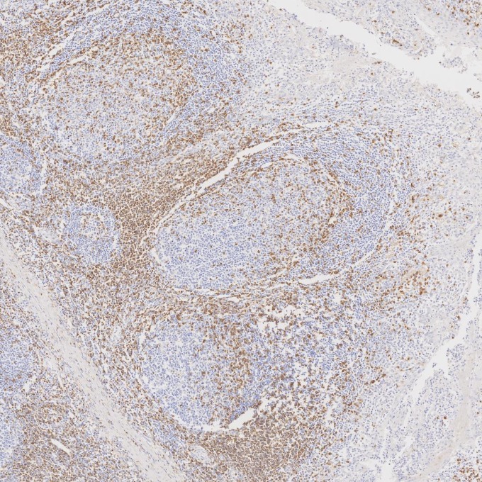 IHC staining of human tonsillitis using 60181-1-Ig