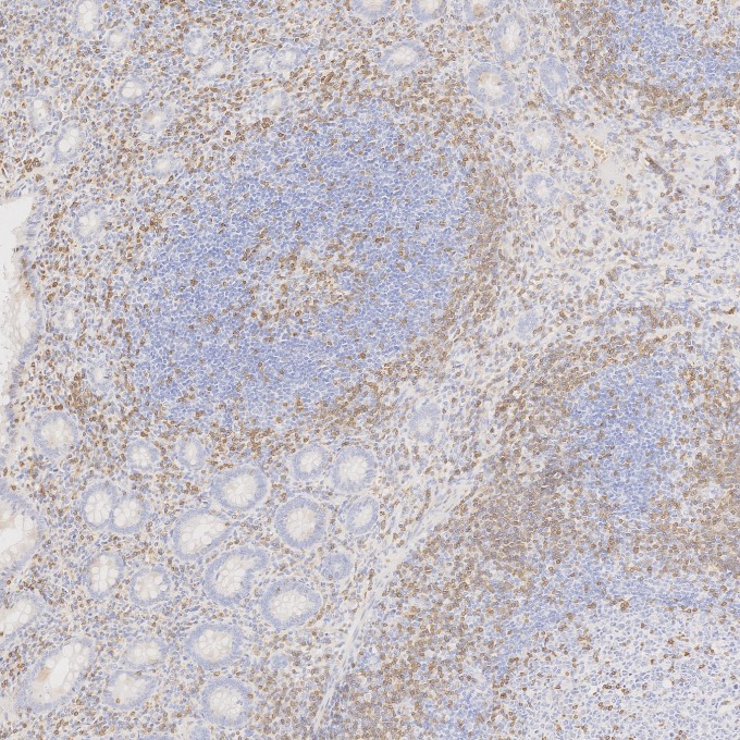 IHC staining of human appendicitis using 60181-1-Ig