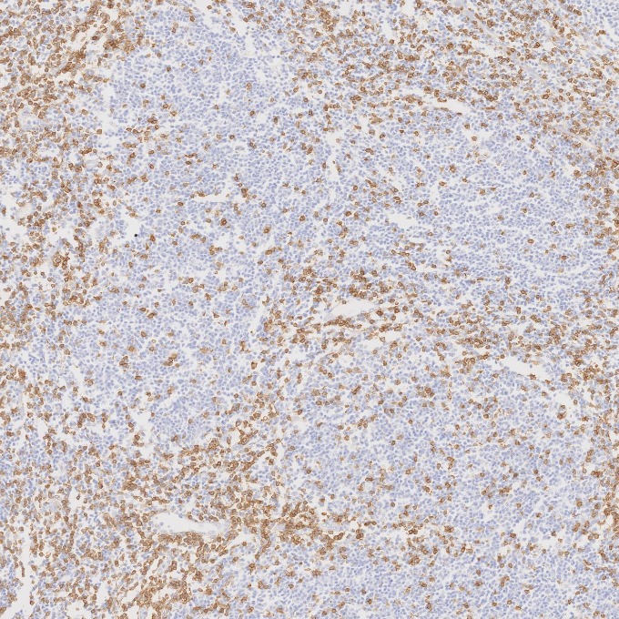 IHC staining of human lymphoma using 60181-1-Ig