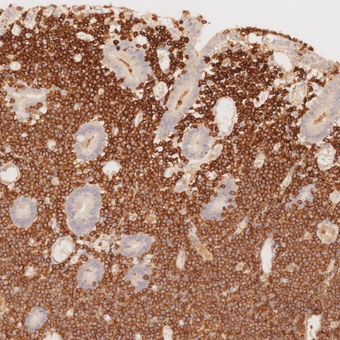 IHC staining of human lymphoma using 60181-1-Ig