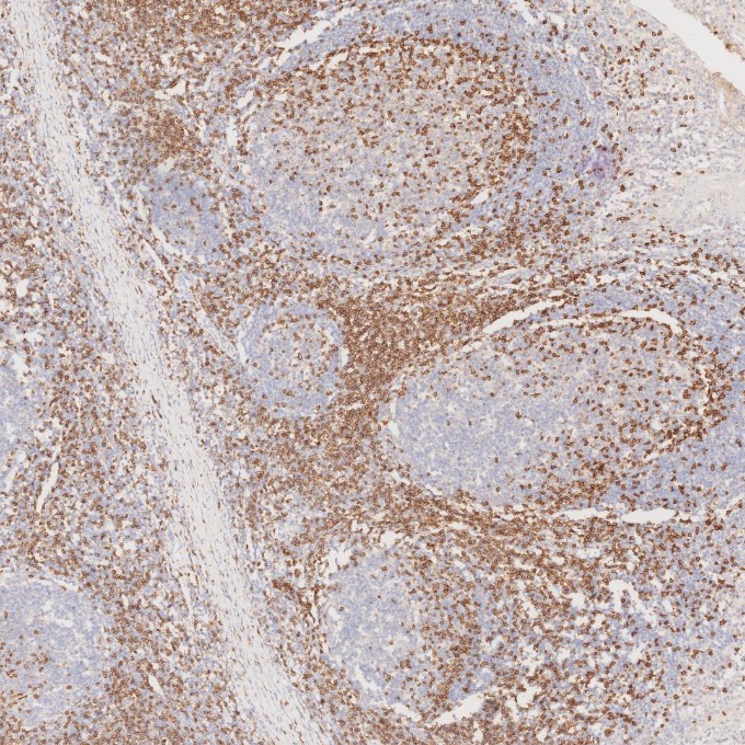 IHC staining of human tonsillitis using 60181-1-Ig