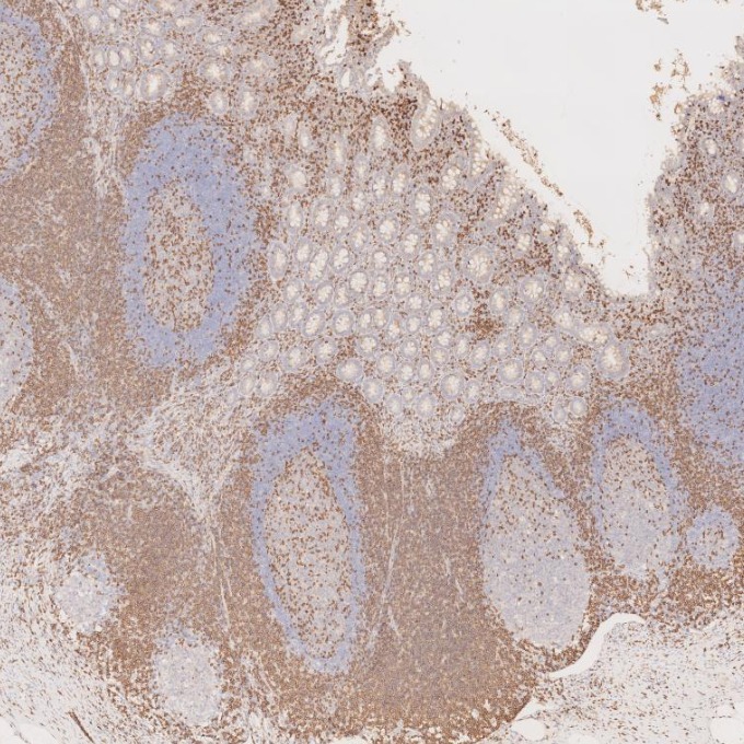 IHC staining of human appendicitis using 60181-1-Ig
