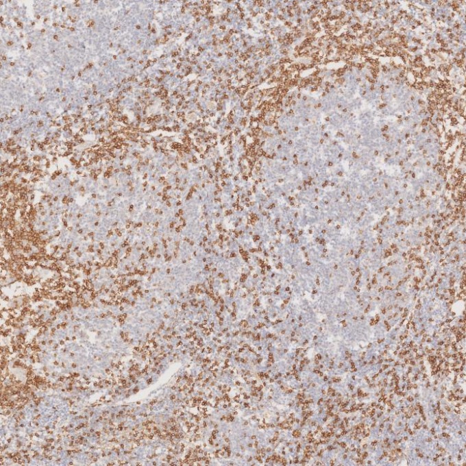 IHC staining of human lymphoma using 60181-1-Ig