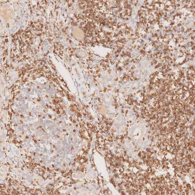IHC staining of human lymphoma using 60181-1-Ig