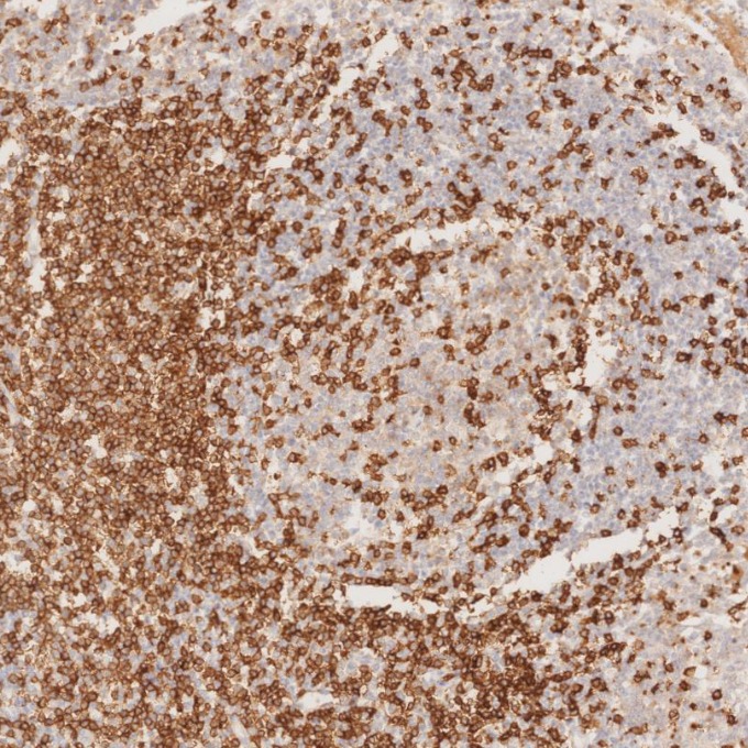 IHC staining of human tonsillitis using 60181-1-Ig