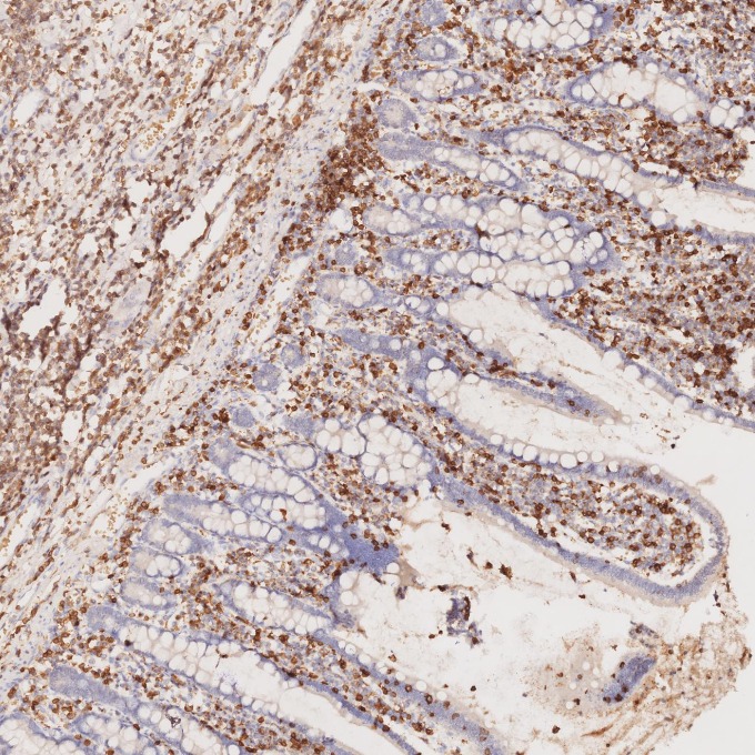 IHC staining of human lymphoma using 60181-1-Ig