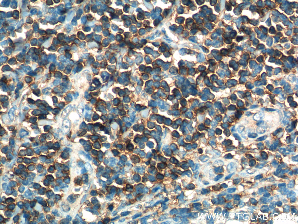 IHC staining of human tonsillitis using 60347-1-Ig